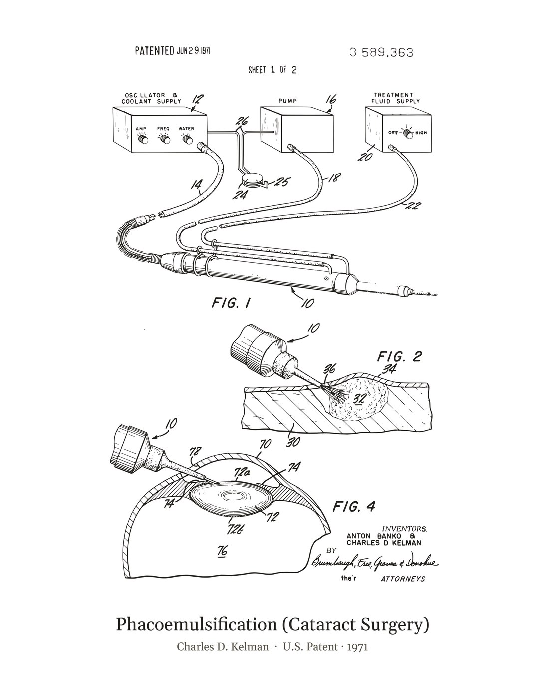 Phacoemulsification (Cataract Surgery) patent art print